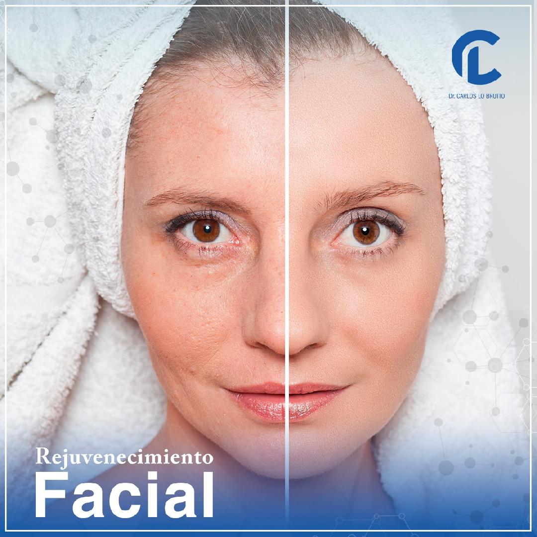 Rejuvenecimiento Facial